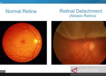 Tampak pada foto kiri retina normal dan kanan ablasio retina, ditandai seperti adanya gelung lapis dari retina yang terlepas sehingga terlihat seperti gumpalan. Jika gumpalan ini semakin banyak terlepas, maka penglihatan pasien semakin menurun. (ANTARA/Tangkapan layar slide presentasi Dr Soefiandi Soedarman, SpM (K) dalam virtual media session JEC Eye Talks, Rabu (24/8/2022))